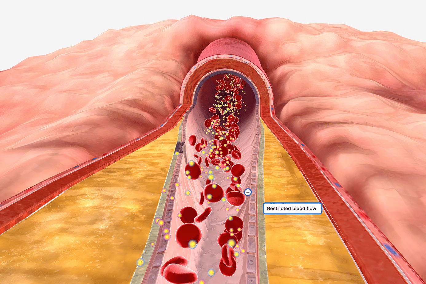 Endovascular